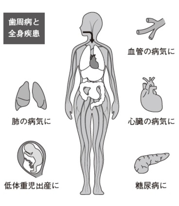 歯周病を放っておくリスク